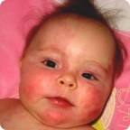 Алисе Тухватшиной провели очередной сеанс обработки лазером