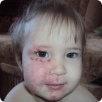 Результат лечения Дианы Вахитовой